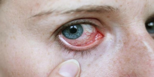 La alergia ocular o "conjuntivitis alérgica" es un proceso bastante común